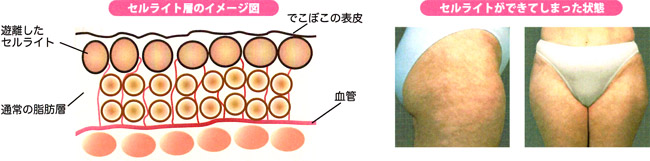 セルライトのイメージ図